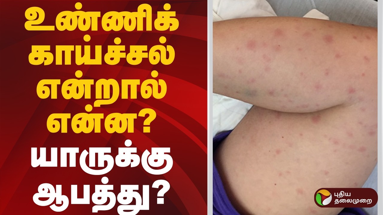 உண்ணிக் காய்ச்சல்: அறிகுறிகள் என்ன? |  Scrub Typhus