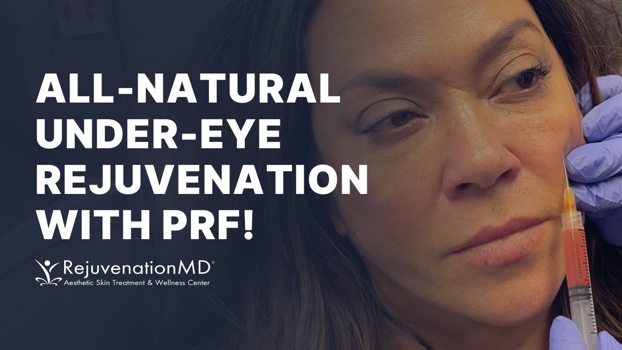 PRF for Under-Eye Bags vs. Tear Trough Filler