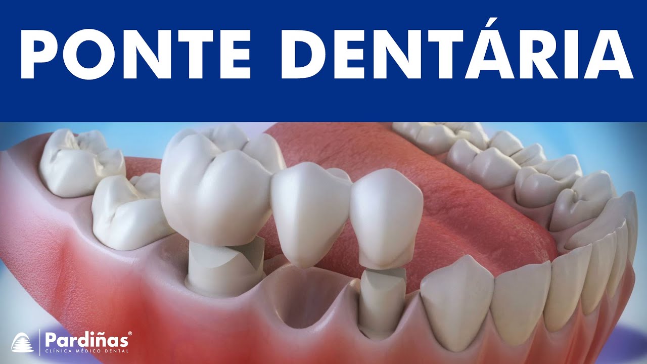 Pr&oacute;tese dent&aacute;ria fixa - Ponte &copy;