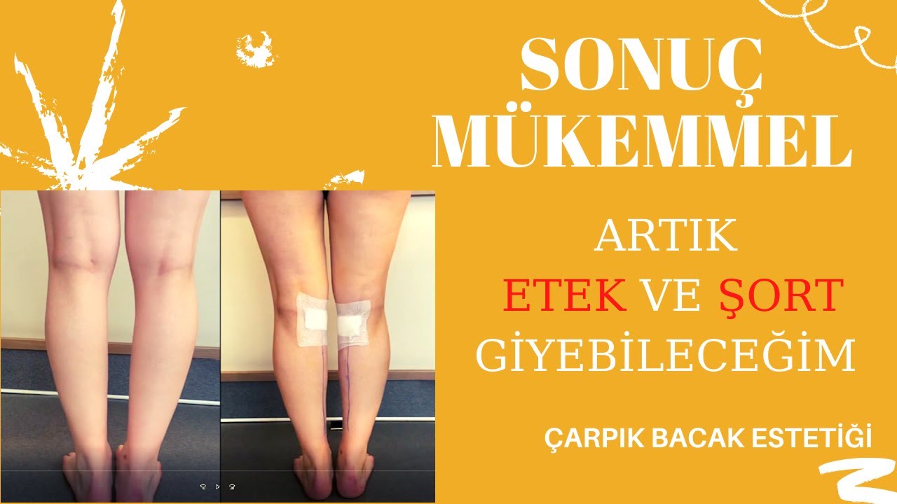 Çarpık Bacak Estetiği II PROTEZ