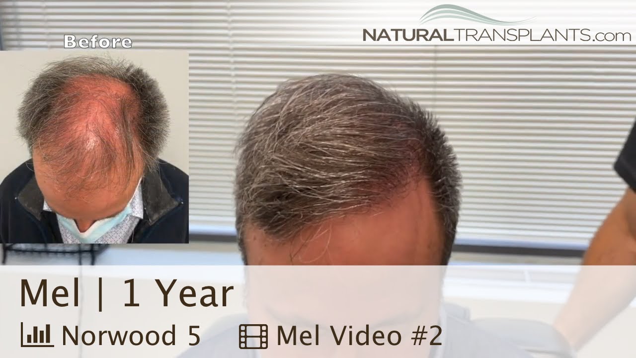 Norwood 5 Hair Transplantation Surgery Results 1 Year Later | Dr. Kevin Blumenthal (Mel)