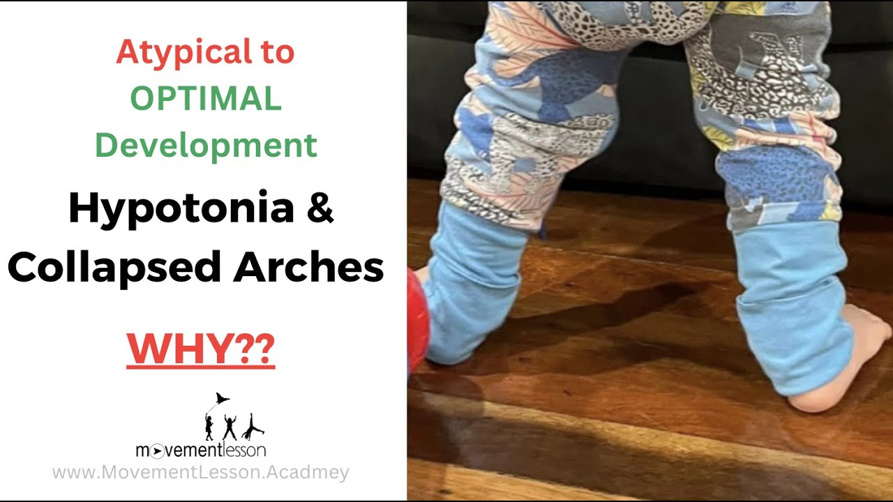 Atypical Development Baby Hypotonia, Low tone & Walking with Collapsed Arches - for Worried Parents