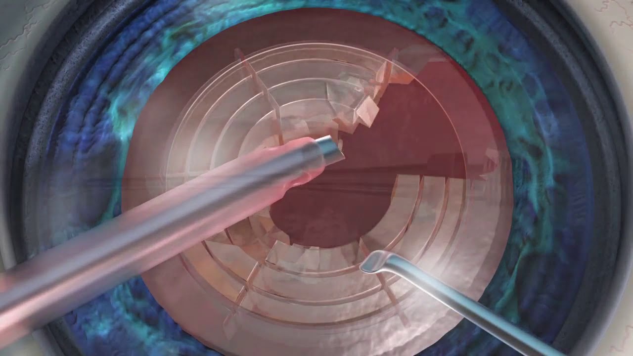 Alcon's Balanced Tip Phaco Needle | Lotus Vision, Cataract Surgeon