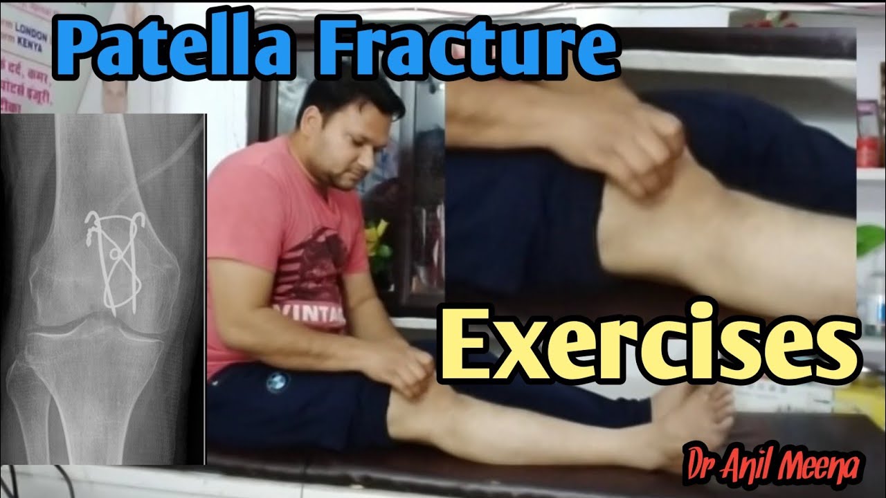 Patella Fracture Recovery Exercises | Patella Fracture Exercises | Patella Fracture Physiotherapy