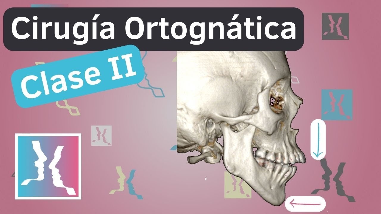Cirugía ortognática: Clase II facial