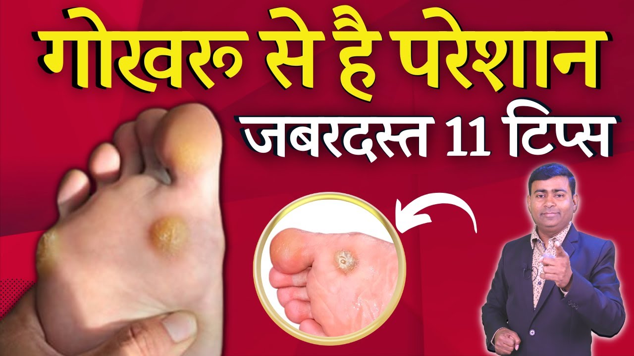 गोखरू से है परेशान- जबरदस्त 11 टिप्स foot corn #corn #gokhru #homoeopathy
