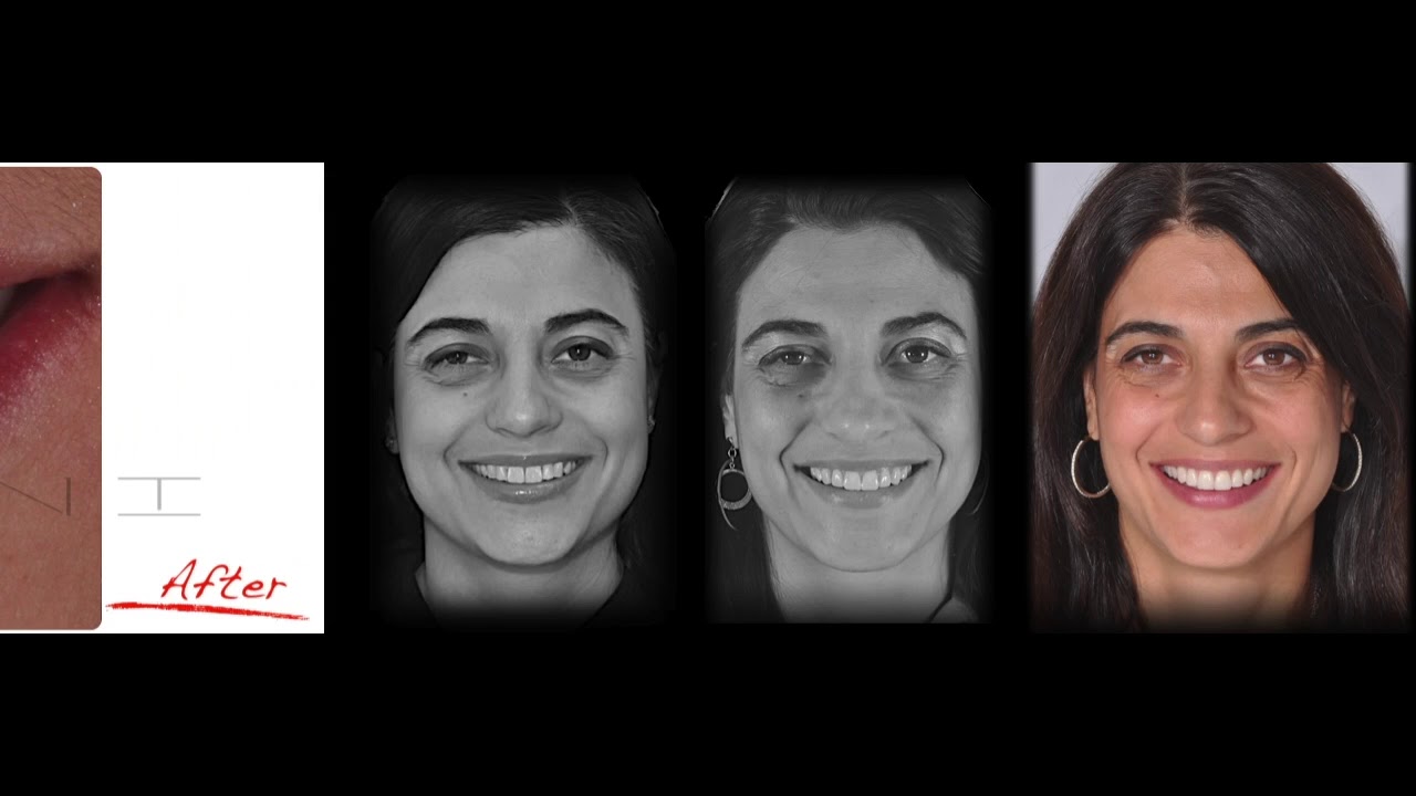 Veneers SDM Marco Veneziani
