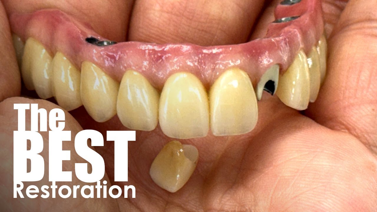 This Is How Dental Patient's Get The Very Best Full-Mouth Restoration