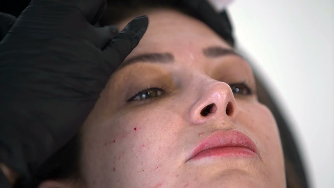 Yüz Lekeleri İçin Kullanılan Xela Rederm Uygulaması