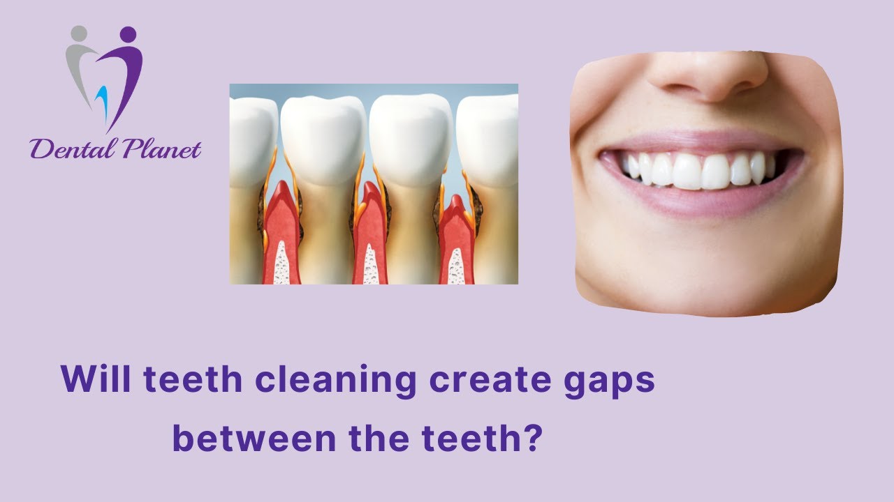 Does teeth cleaning create gaps between teeth and make it weak? Is professional cleaning harmful? 