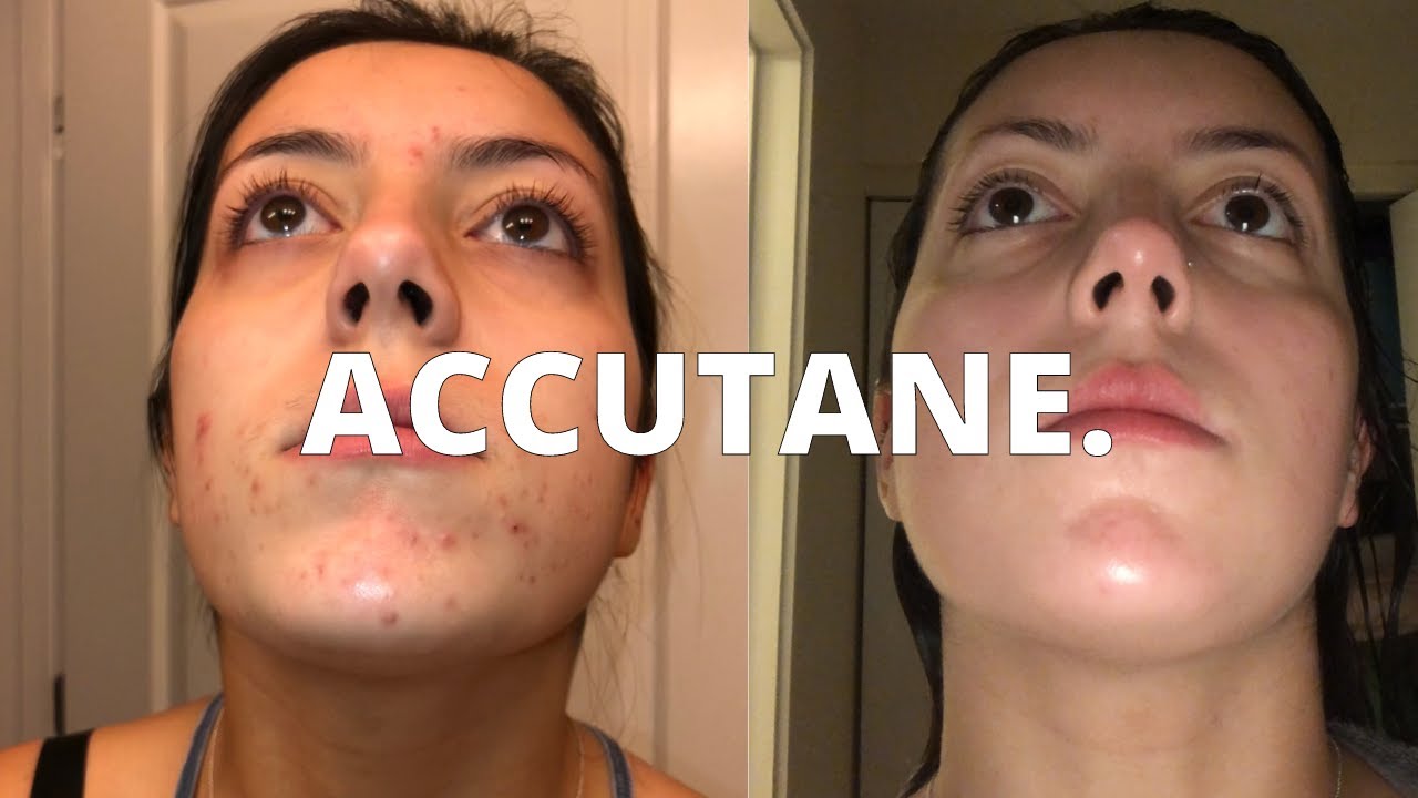 watch this before starting ACCUTANE // my experience, tips, and products you need!