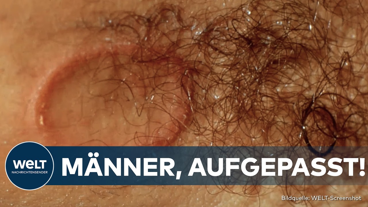 PILZ IN BARBERSHOPS: M&auml;nner, aufgepasst! Immer mehr Kunden haben nach ihrem Friseurbesuch Hautpilz!