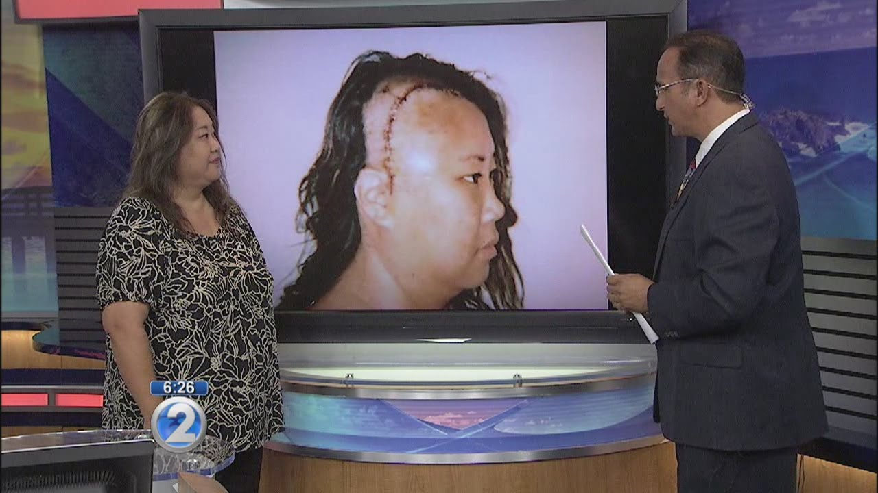 Moyamoya survivor needs second surgery