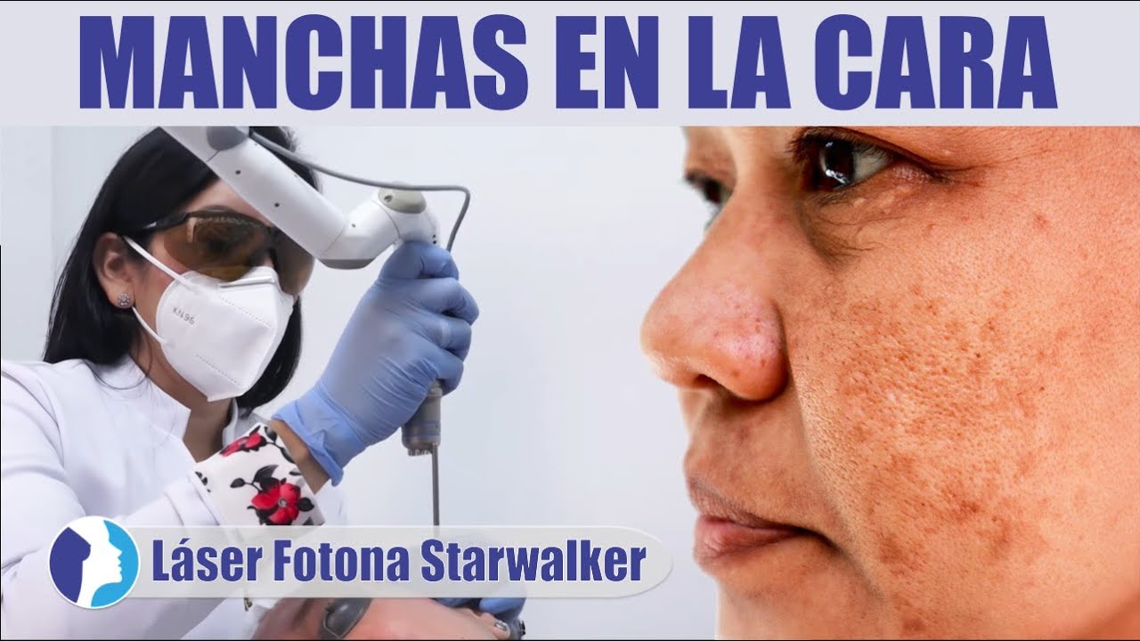COMBATE el MELASMA del ROSTRO 👩 Láser Fotona Starwalker 😱 Dra Marissa Charaja HM Aesthetic y láser