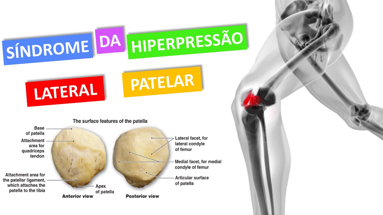 SÍNDROME DA HIPERPRESSÃO LATERAL DA PATELA
