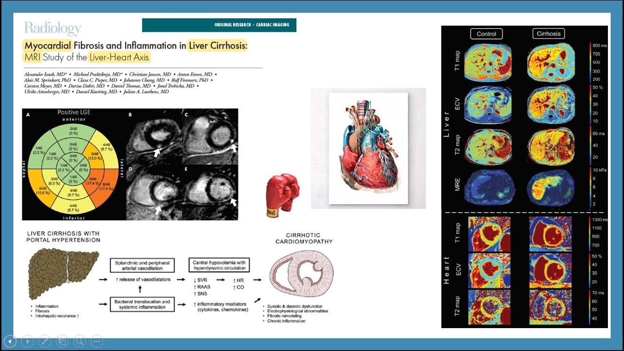 Myocardial Fibrosis by Daniel Hansen