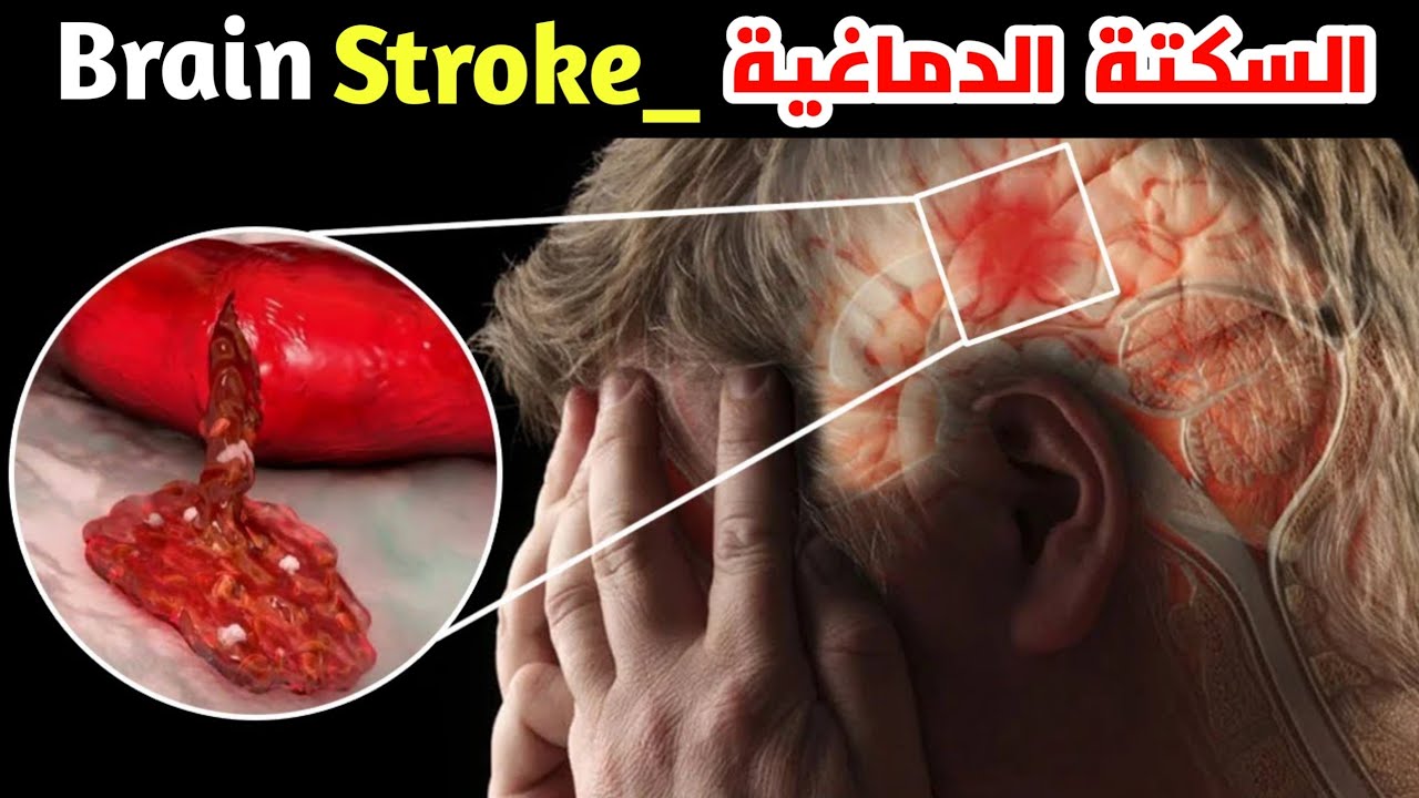 ماهي السكتة الدماغية؟! وشاهد كيف تحدث_what is brain stroke