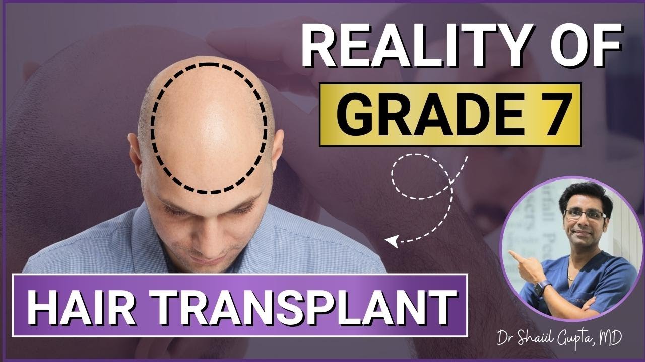 Hair Transplant - Reality of Grade 7 | Grade 7 Baldness Hair Transplant  | Grade 7 Hair Transplant