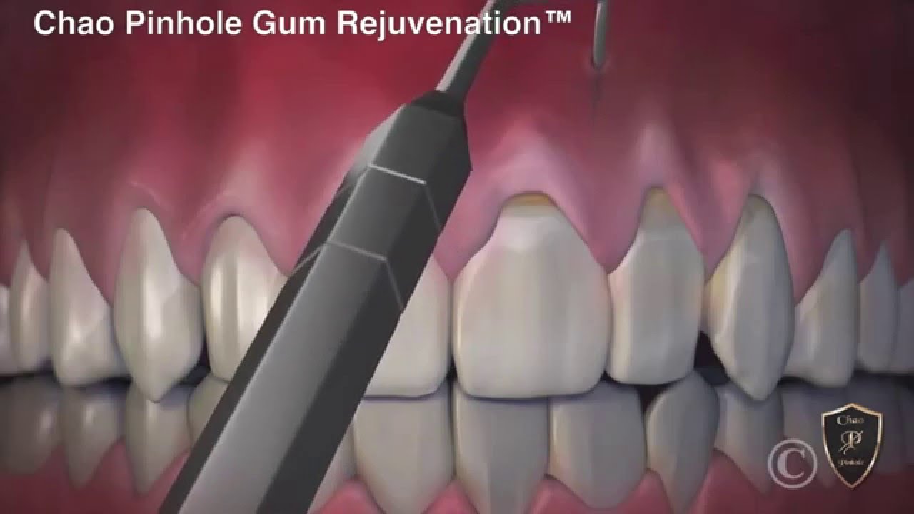 Chao Pinhole Surgical Technique Dr. Noroozi IMPrESS Perio Vancouver Periodontist