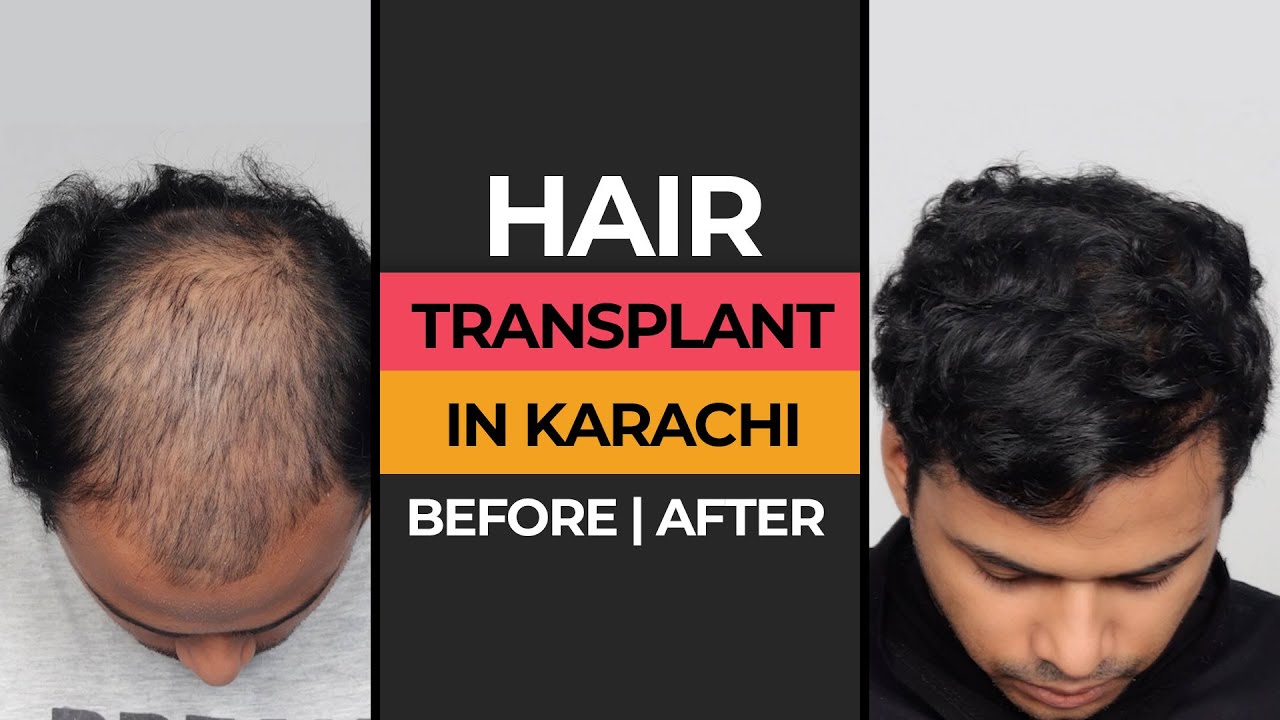 Hair Transplant in Karachi | Before & After Results