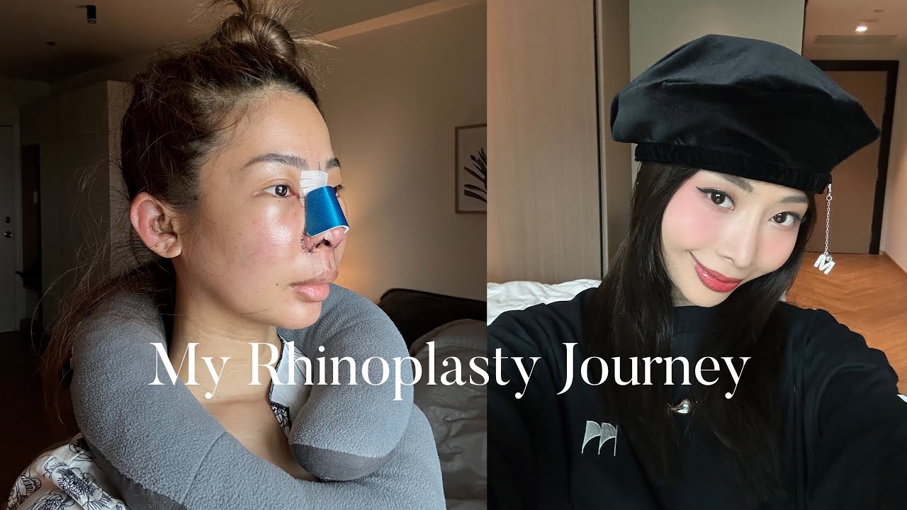 MY RHINOPLASTY JOURNEY 👃🏼✨