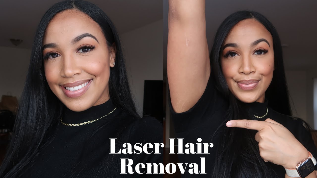 Laser Hair Removal VLOG | Waxing vs. Laser | My Experience