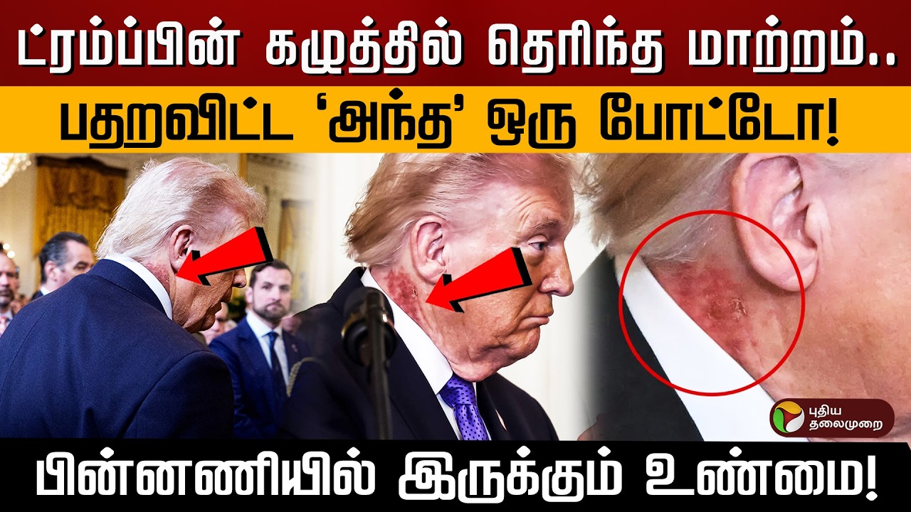 ட்ரம்ப்பின் கழுத்தில் ஏன் இந்த மாற்றம்? பின்னணியில் இருக்கும் உண்மை என்ன? | PTD