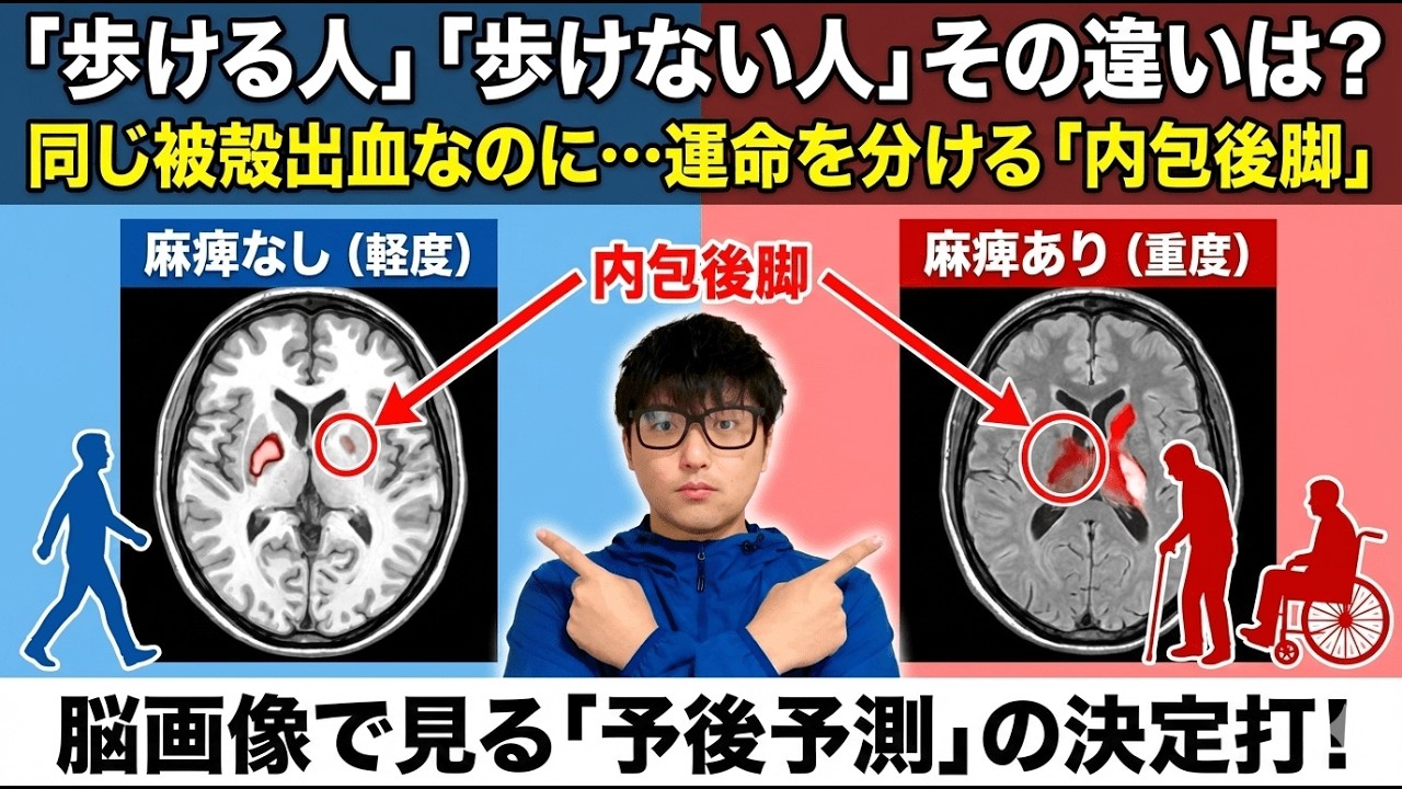 【被殻出血】歩けるようになる？脳画像で判断する「予後予測」と内包後脚への出血波及レベル