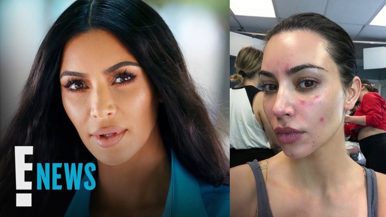 Kim Kardashian Opens Up About Painful Struggle With Psoriasis | E! News
