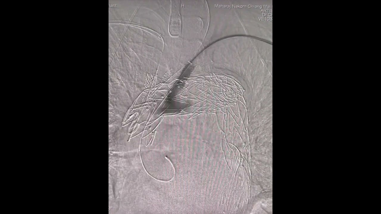 Physician-Modified Endovascular Grafts for Zone-0 Thoracic Endovascular Aortic Repair