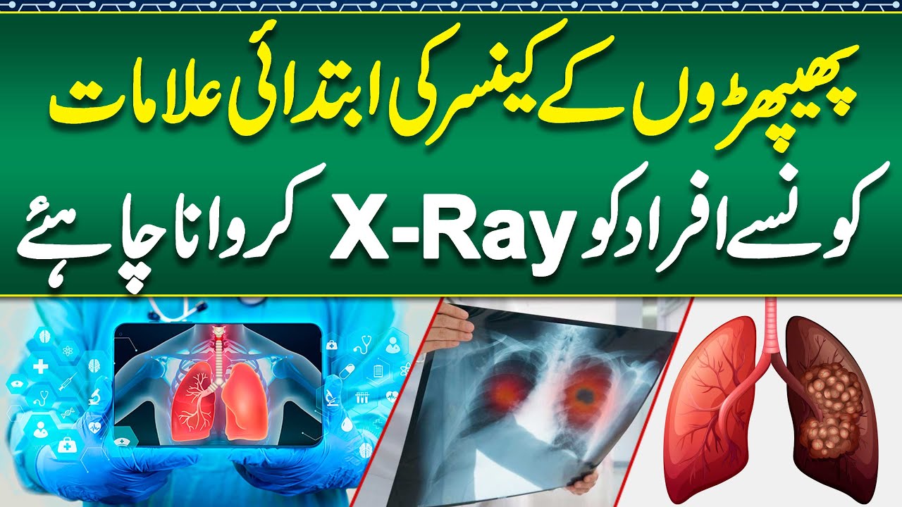 Lung Cancer Ka ilaj - Lung Cancer Symptoms, Causes and Treatment - Stages of Lung Cancer