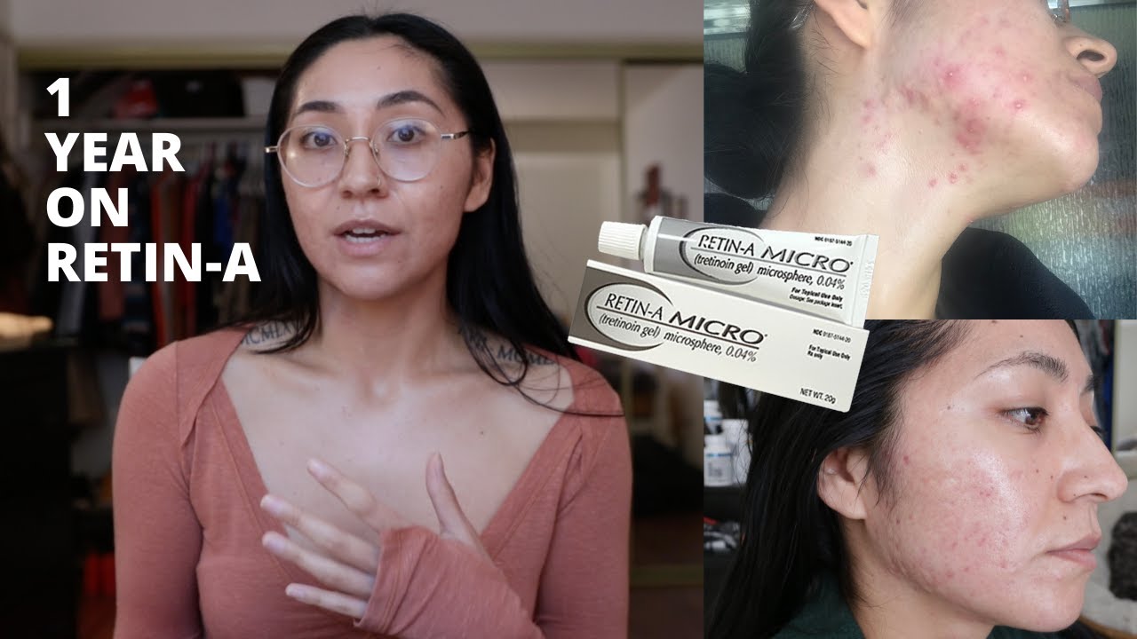 My experience using Retin-A for A WHOLE YEAR! w/ before + after pics
