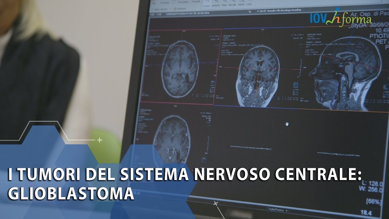 I tumori del sistema nervoso centrale: glioblastoma