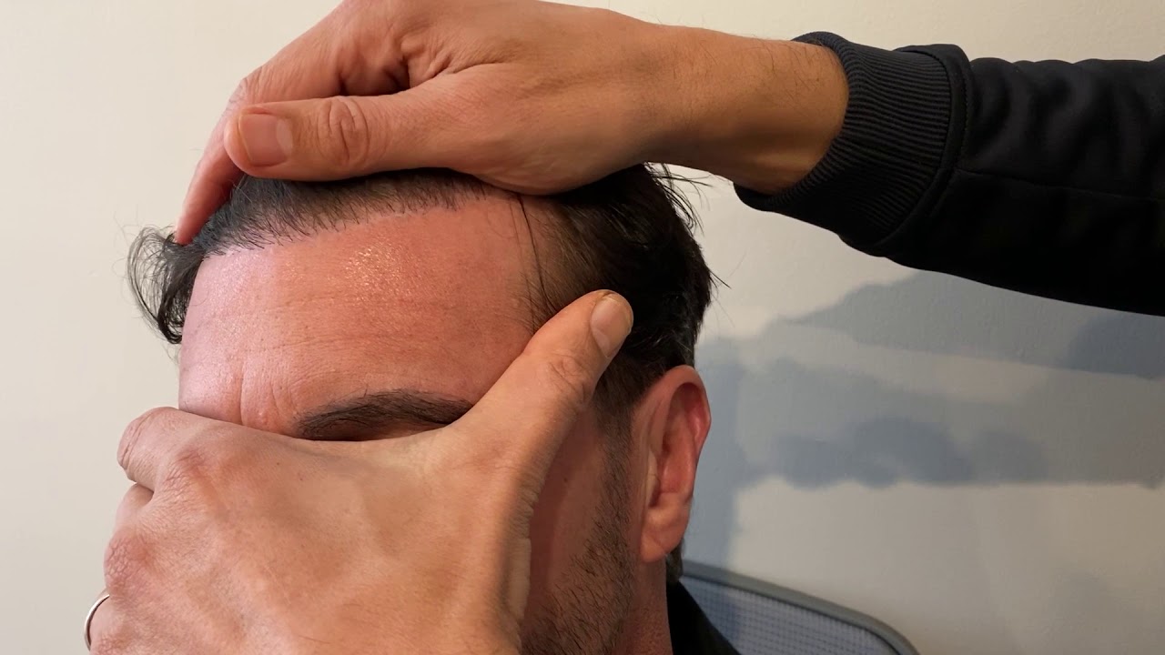 Dr. Epstein with a patient 6 months after hairline lowering/forehead reduction surgery.