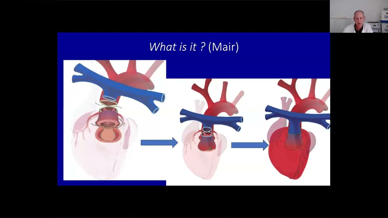 European Perspective, with Focus on the Double Root Translocation - Mark G. Hazekamp, MD