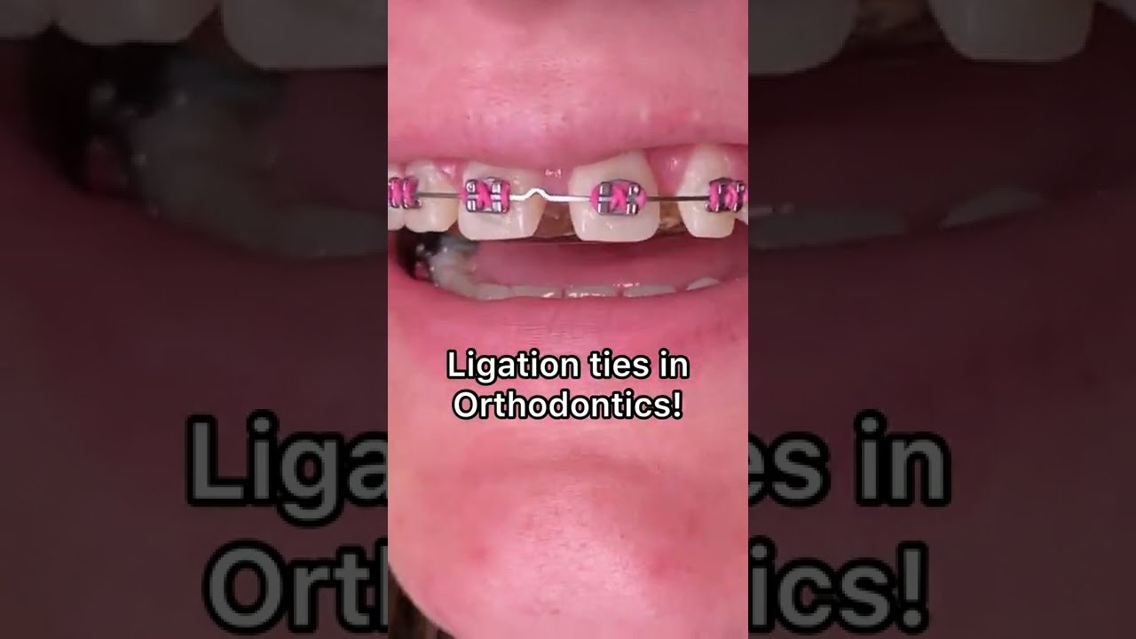 Виды лигирования с брекетами — семейная стоматология Tooth Time, Нью-Браунфелс, Техас