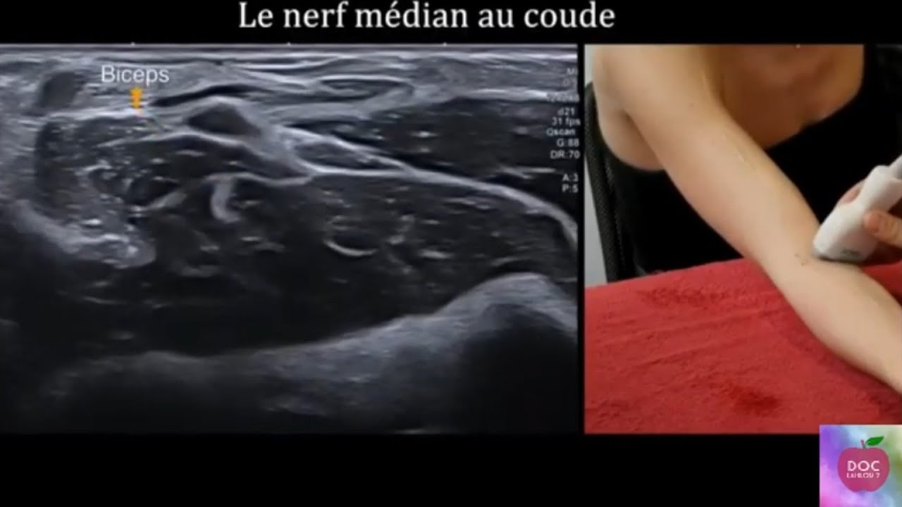 Echographie du nerf médian