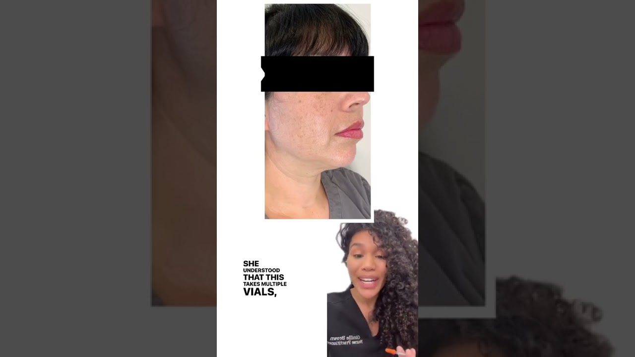 Kybella injections before and after, fat dissolving double chin, nonsurgical permanent fat removal
