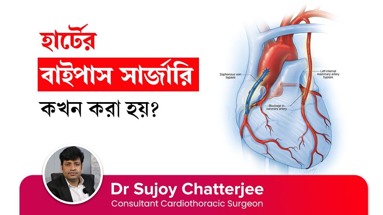 করোনারি আর্টারি বাইপাস সার্জারি – কখন ও কিভাবে  করা হয় | Heart Bypass Surgery CABG in Bangla