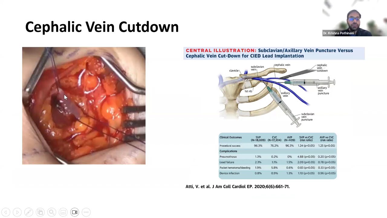 Pace-Maker Implantation : Anatomy, Access and Lead Positioning
