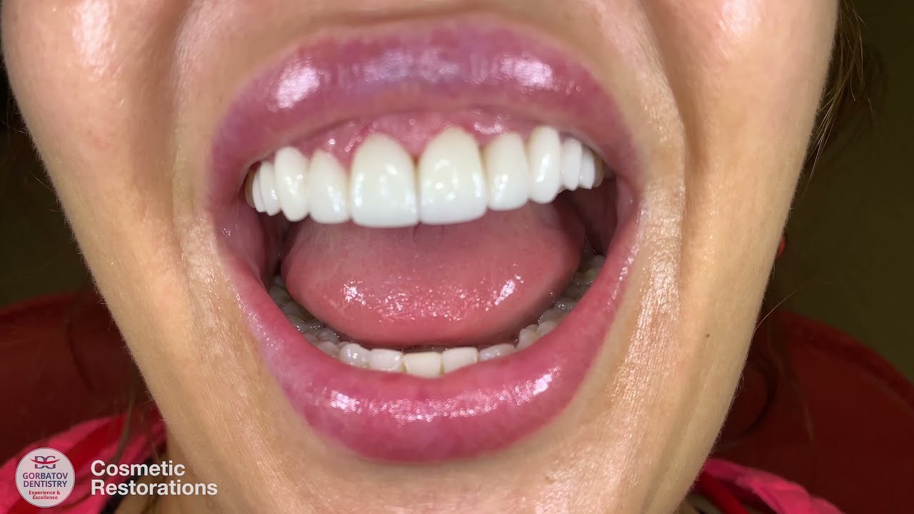 Cosmetic Restorations - Veneers, Gum Lifting and Teeth Reshaping