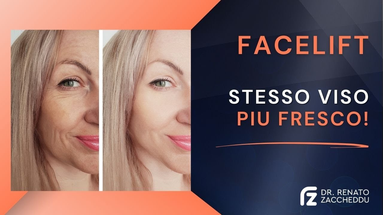 Facelift Naturale: Ringiovanire Il Volto Senza Stravolgerlo