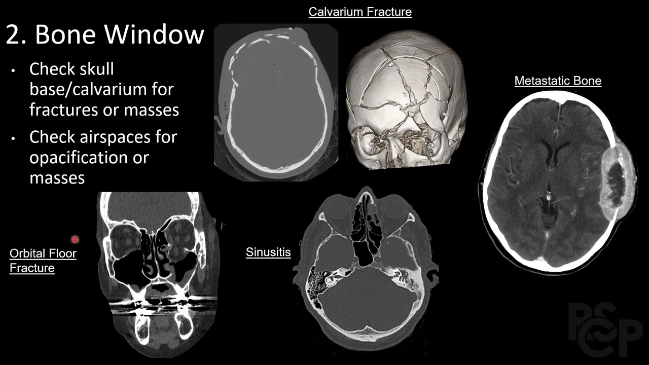 Intro to Neuro CT - Radiology Education - RSCP Video Curriculum