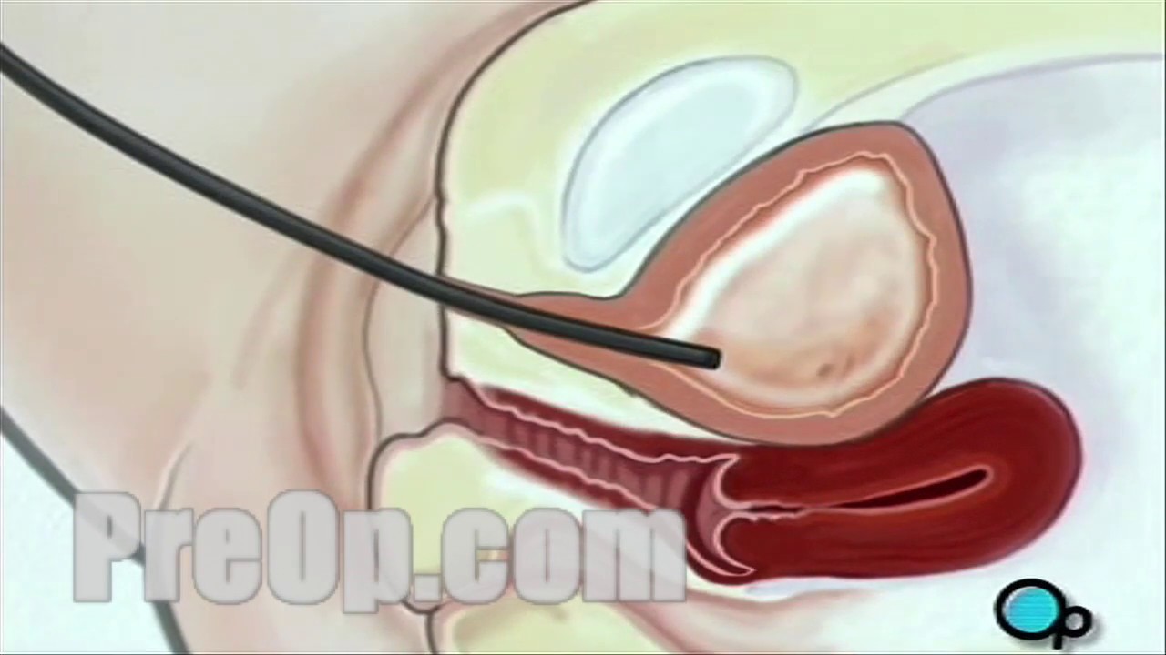 Cystoscopy Female Vaginal Surgery PreOp&reg; Patient Education