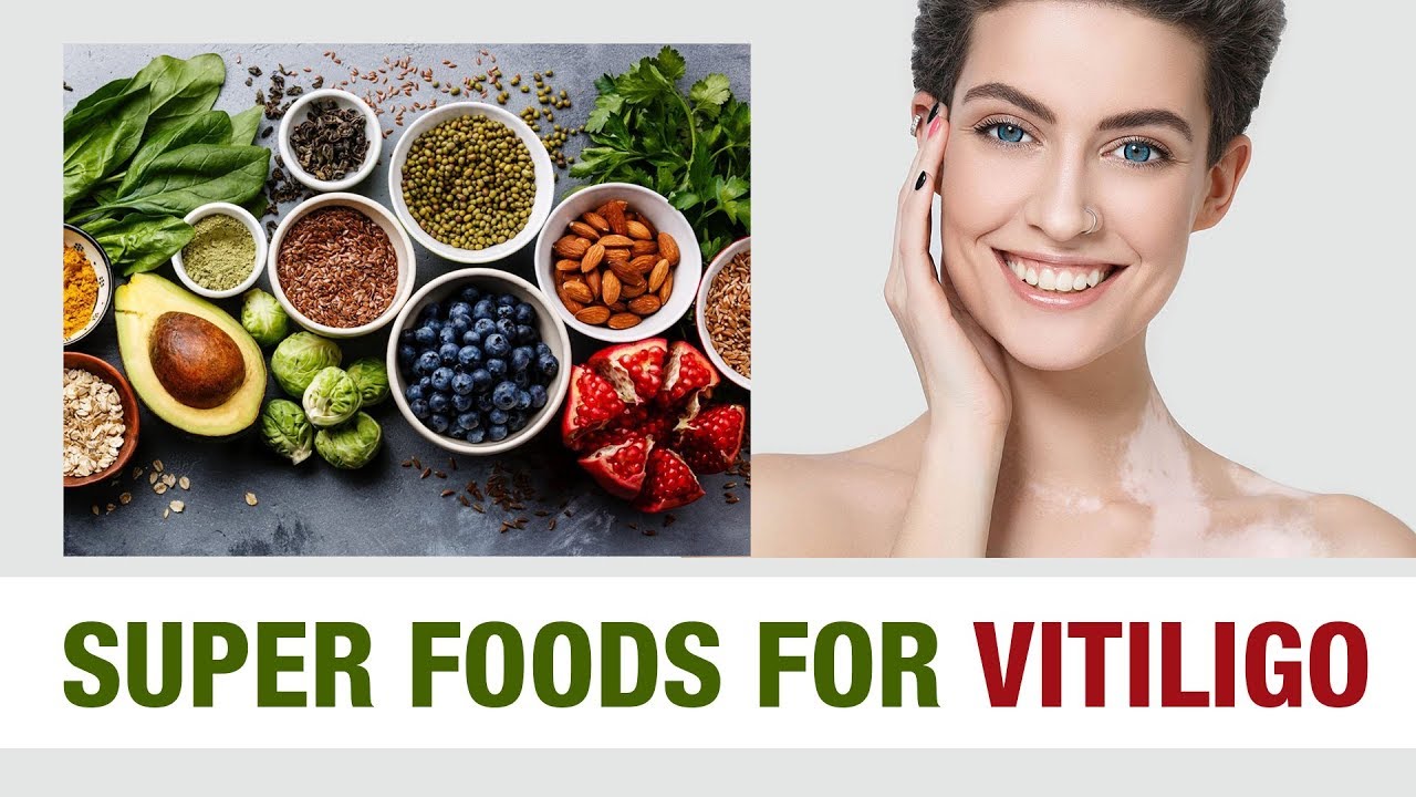 Super Foods for Vitiligo || Aimil Healthcare || Dr. Nitika kohli