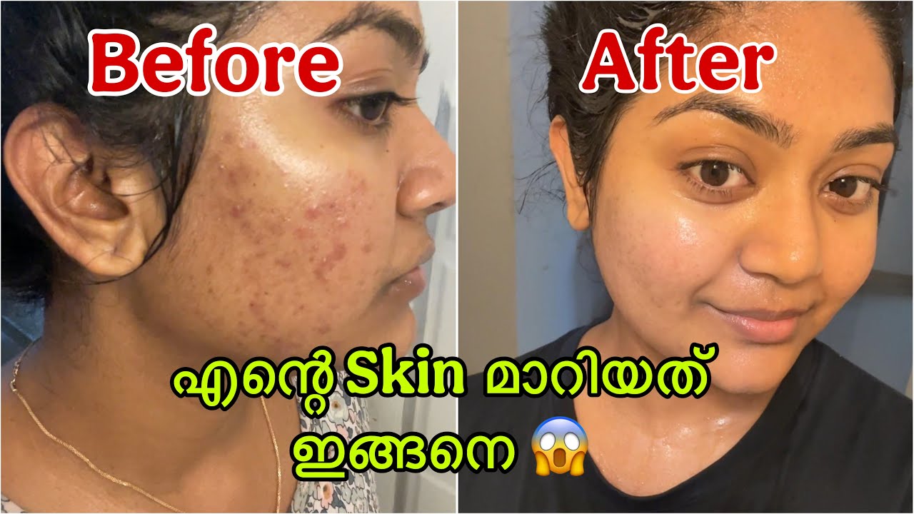 My Acne Story ഞാൻ മുഖം Clear ആകാൻ ചെയ്ത കാര്യങ്ങൾ എന്റെ Skincare Journey In Malayalam