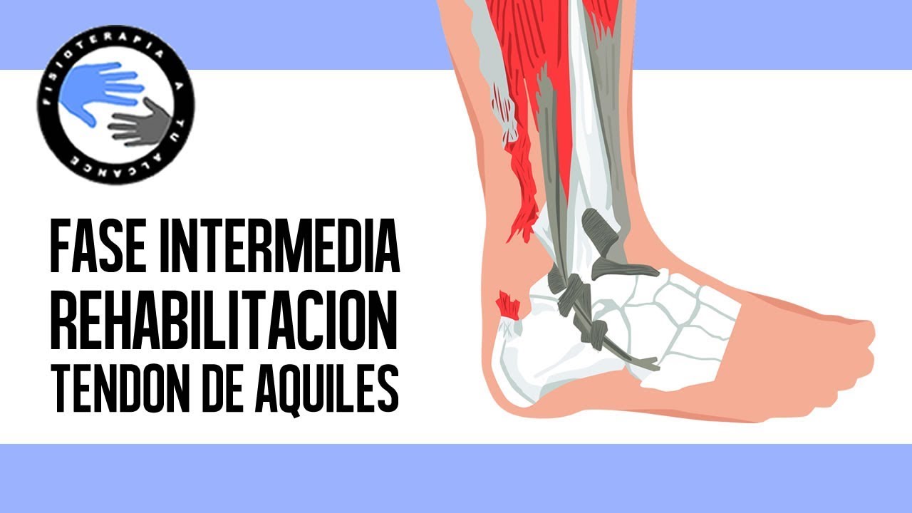 Rotura del tendon de aquiles, ejercicios y rehabilitacion postcirugia en la fase intermedia