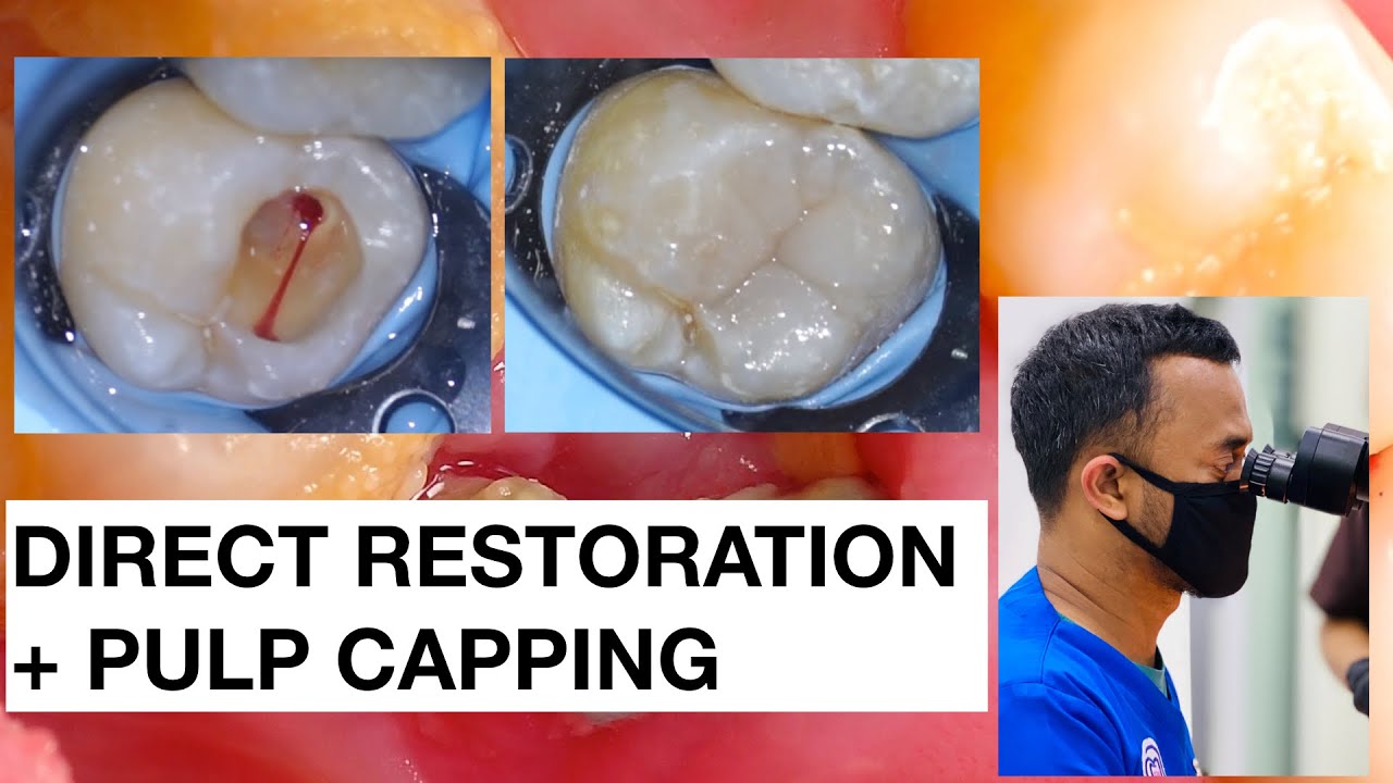 Direct Restoration with Pulp Expose | Pulp Capping | Dokter Gigi Griya RR