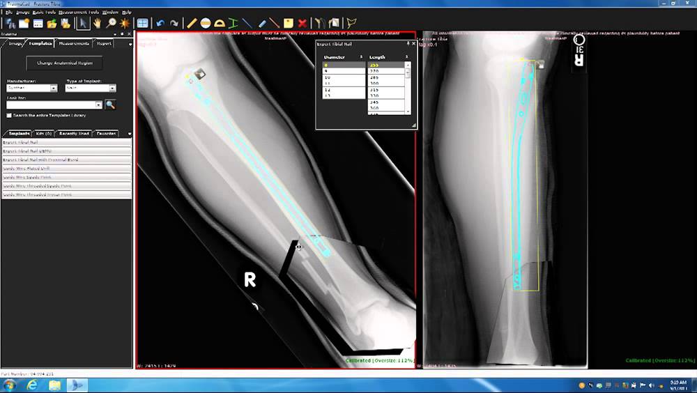 TraumaCad Deformity Course Part 1 - Introduction
