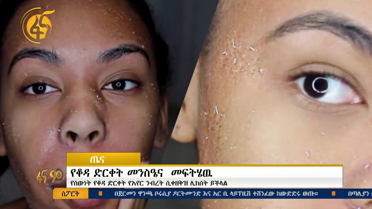 የቆዳ ድርቀት መንስኤና መፍትሔው
